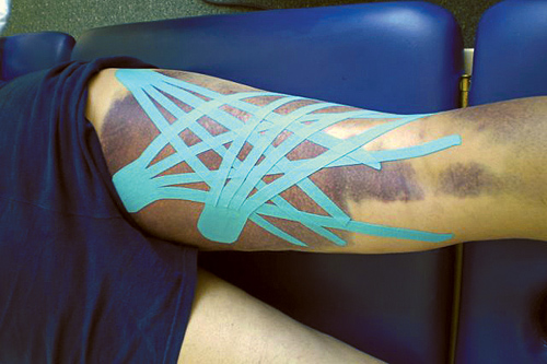 Therapeutic Taping for Lymphatic Drainage